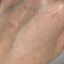 용메디칼 | 이소티논 6개월 복용 후기 그리고 이천 성인여드름 피부관리샵 추천 미그리다