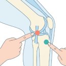 무릎 안쪽 통증 원인 4가지 - 계단 내려갈 때, 쪼그려 앉을 때 아프다면 (한의사 설명) 이미지