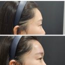 엘브이의원 | 부산 이마필러 잘하는 곳 연산동 LV 의원