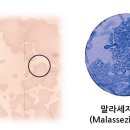 어루러기[Pityriasis versicolor] 이미지