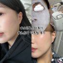 금호초교 | 신금호역 한의원 초음파 리프팅•스킨부스터 시술 (10일차 후기 기록)