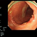 장결핵[intestinal tuberculosis] 이미지
