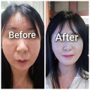 애프터팜 윤약국 | 엘라비에 리투오 후기 리투오셀 스킨부스터 통증 및 효과