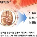 * 뇌출혈로 쓰러져도 엄지발가락을 만지면 회생 가능 * 이미지