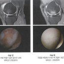 관절연골 재생술(자가연골 배양 이식술VS제대혈 줄기세포 재생술) 이미지