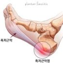 발뒤꿈치 통증 원인 (족저근막염) 이미지