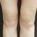 엘브이의원 | 부산 센텀 엘브이의원에서 50대 울엄마 무릎 필러 해드린 솔직 후기!
