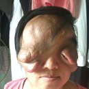 종양 얼굴 덮어 오른쪽 시력 잃어, 1차 수술 마쳤지만 추가 수술 시급 --베트남인 티엔씨 이미지