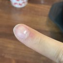 둔산태평양약국 | 손가락 사마귀 냉동 치료 과정(물집, 딱지), 대전 더블유피부과