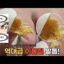 ﻿발톱안에 머리카락?! 이물질 많은 역대급 발톱! amazing fungal toenail 이미지