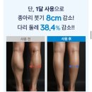 구원3 | 심한 종아리붓기 평발구원템 아치크 찐 사용 후기ㅣ가격, 교정효과