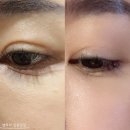 눈밑꺼짐필러 가나브이 받은 전후 후기! 부작용X, 강남구청역피부과 내돈내산