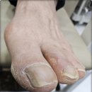 까망네일 | 대전 대흥동 발톱무좀 풋케어 전문샵 방문 후기 닥터아이티엔 네일 까망아트