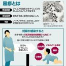 풍진 코로나대책의 완화로 재유행？…1962~1978년도 출생의 남성은 항체검사가 무료 이미지