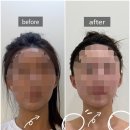 UR(원주시)-[신지정로]-상-12 | 원주 얼굴 윤곽관리 추천♥ 작은 얼굴 비대칭 관리 받고 온 후기(신부관리 팁!)