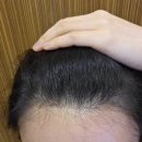 우원빌딩앞 | 내돈내산 미금 두피문신 잔흔 제거 <브로우원> 솔직후기