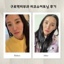 구로역 | 구로역피부과 피코슈어토닝 후기 , 일주일 피부변화 기록!