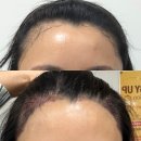 로데오사우나 | 압구정로데오 L성형외과 M자 절개모발이식 후기, 통증부터 비용까지 솔직하게