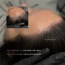 정헤어라인 - 26898 | 광주두피문신 여자 헤어라인 후기, 2년 전 모발이식을 받았음에도 두피문신을 받게 된 이유