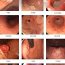 위염 위궤양 차이를 확인한 후 관리해 보시기 바랍니다 이미지