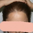 선헤어라인 이미지