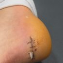 1013 | 뒤꿈치 봉합후기 [3탄] (0925~1013)