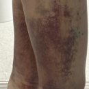 달고리 | 부산허벅지지방흡입 후 허파고리 라인, 눈바디 변화 한달차 후기