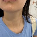 편평사마귀 제거 후기｜서울한의원에서 내돈내산으로 제거하고 온 솔직 후기