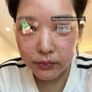 루나안경 | 905개 주근깨 제거하기 루나의원 루비레이저 내돈내산 후기 1일~4일차 수포부작용?!
