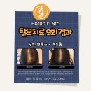 안목안경 | 광주 모발이식 병원 진짜를 가려내는 진실