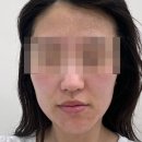 메디플렉스 | 안산 중앙동 피부관리샵 “에이블메디스킨” :: 여드름피부 2년간 300만원 투자한 내돈내산 후기