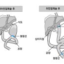 위암 이미지