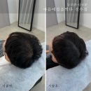 다전헤어라인 | 효자동두피문신가격 싼 데만 찾다 망했습니다
