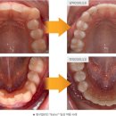 링구얼라인 이미지