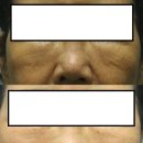 152 | [창원스킨부스터시술] 스킨부스터, 진짜 피부 개선될까?후기 &amp; 데이터 분석