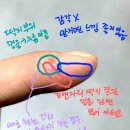 손가락 신경봉합술 산재 /재활운동 - 산재종결/ 끝