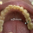 김상욱치과의원 | 대구임플란트잘하는치과, 전문의 실제 사례