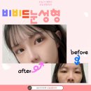 비비드성형외과의원 | 눈모양에 따라 다른 쌍꺼풀수술 결과 비비드 눈성형 쌍수전후후기