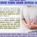 담낭암 초기 증상 원인 치료 예방 방법 이미지