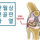 반월상 연골판 파열//관절내시경 이미지