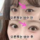 [강남 신사역]내돈내산 한쪽눈 쌍꺼풀수술후기(자연유착)