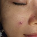 신세계한의원 | 광주한의원 신세계백화점 건너편 흉터전문한의원 아이스픽흉터치료 3회차 후기