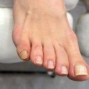 문제성 손, 발 오감네일 | 인천문제성발톱 문제성 손, 발 오감네일 도화점 두껍고 파고드는 발톱 관리받았어요