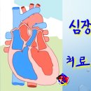 사암침, 사암침법 - 심장판막 질환 치료 방법 - 비과학적 양의학 112 이미지