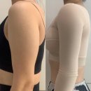 인천팔지방흡입 당일 생생후기 (통증, 붓기, 압박복 등)