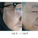 연합의원 | 평택 송탄 서울아산연합의원 편평사마귀 흑자 치료 후기