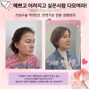 브이에스라인의원 | 안면거상술 전후 김포 강서 고촌 1등