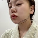 [이중턱지방흡입, 엘라스티꿈 실리프팅] 원탑성형외과에서 이중턱 지방흡입+리프팅 한지 3주차 리얼후기