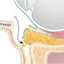 청담미의원 | 중장년의 하안검수술과 재수술, 애교살 복원을 중심으로..