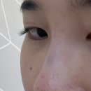 대구에서 필러를 녹이기~!